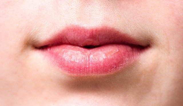 Cara Menghilangkan Bintik Putih di Bibir